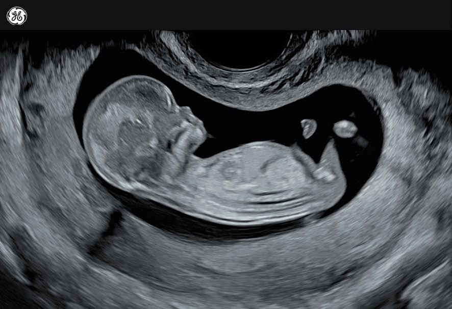 Prenatal ultrasound